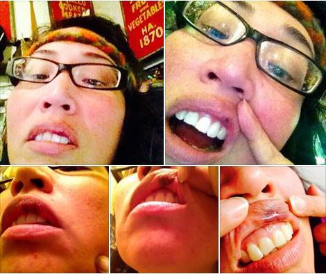 Audrey Siegel showing off her wounds...